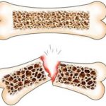 pri-osteoporozi